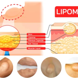 Lumpless Lipoma Treatment Cream - Image 9