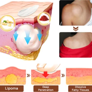 Lumpless Lipoma Treatment Cream - Image 10