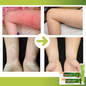 Intensive Eczema Relief Cream - Image 4