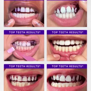 Purple Teeth Whitening Strips - Image 8