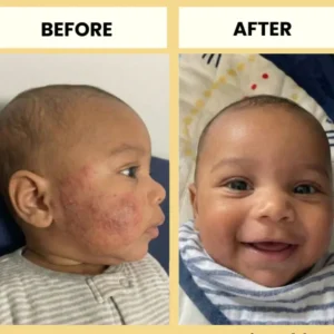 Honey Eczema Cream - Image 8