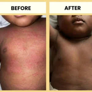 Honey Eczema Cream - Image 9