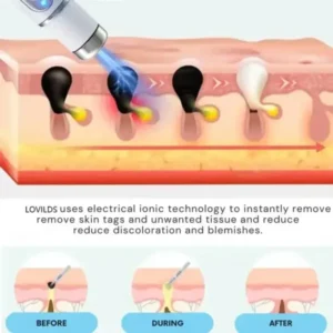Non-Invasive Mole and Wart Removal Laser Pen - Image 2