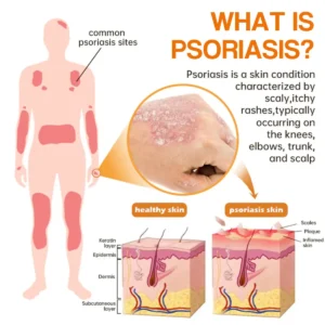PsoriaHeal Bee Venom Psoriasis Treatment Spray - Image 6