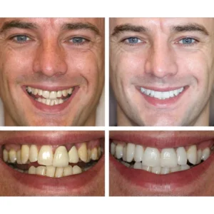 Esencia blanqueadora de dientes - Image 8