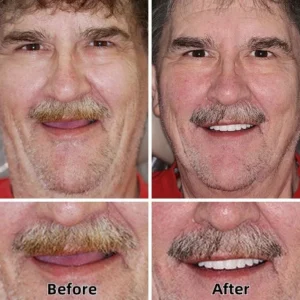 -Advanced Custom-Fit Functional Dentures - Image 3