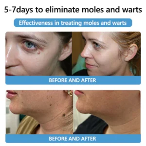 Bee Venom Mole and Wart Treatment Cream - Image 4