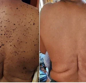 Bee Venom Mole and Wart Treatment Cream - Image 3