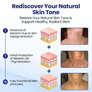 Vitiligo Spray: Psoralen-Powered Relief for White Spots & Irritation - Image 4