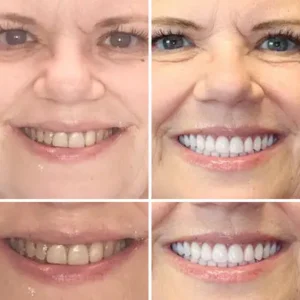 Advanced Customized Full Denture Set - Image 7