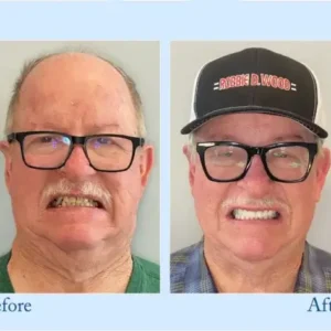 Custom-Fit Functional Dentures – Perfectly Fitted in Minutes at Home - Image 10