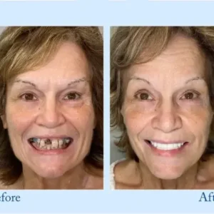 Custom-Fit Functional Dentures – Perfectly Fitted in Minutes at Home - Image 8