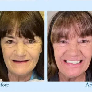 Custom-Fit Functional Dentures – Perfectly Fitted in Minutes at Home - Image 9
