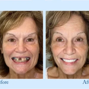 Custom-Fit Functional Dentures - Image 8