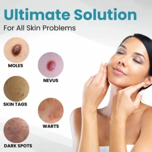 Non-Invasive Mole and Wart Removal Laser Pen - Image 3
