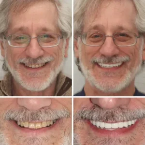 Custom-Fit Functional Denture - Image 2