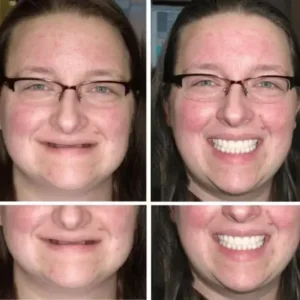 Custom-Fit Functional Denture - Image 9