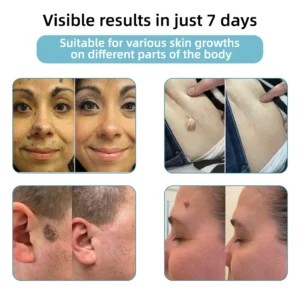 Non-invasive Mole & Wart Removal Laser Pen - Image 3