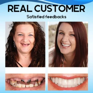 Silicone Reline Denture Set - Image 6
