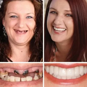 Advanced Customized Full Denture Set - Image 9