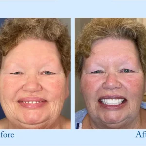 Custom-Fit Functional Dentures – Full Set - Image 10
