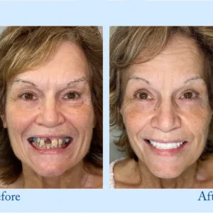 Custom-Fit Functional Dentures – Full Set - Image 11