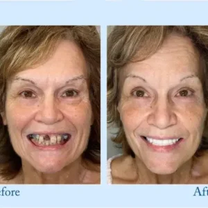 Custom-Fit Functional Dentures — Perfectly Fitted in Minutes at Home - Image 10
