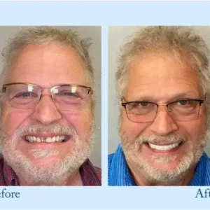Dentures - Image 7