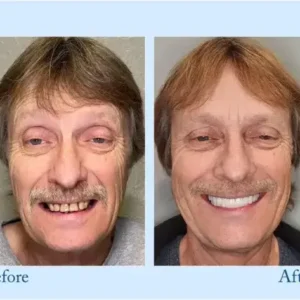 Dentures - Image 9