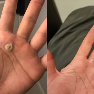 𝐁𝐞𝐞 𝐕𝐞𝐧𝐨𝐦 𝐌𝐨𝐥𝐞 𝐚𝐧𝐝 𝐖𝐚𝐫𝐭 𝐓𝐫𝐞𝐚𝐭𝐦𝐞𝐧𝐭 𝐂𝐫𝐞𝐚𝐦 - Image 6