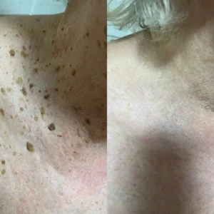 𝐁𝐞𝐞 𝐕𝐞𝐧𝐨𝐦 𝐌𝐨𝐥𝐞 𝐚𝐧𝐝 𝐖𝐚𝐫𝐭 𝐓𝐫𝐞𝐚𝐭𝐦𝐞𝐧𝐭 𝐂𝐫𝐞𝐚𝐦 - Image 7