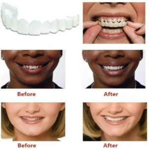 New Plus Protection Snap-On Dentures - Image 3