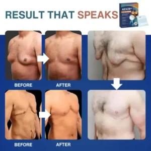 Nano-Microneedle Chest-Sculpt Bio-Patch (𝐉𝐮𝐬𝐭 𝐨𝐧𝐜𝐞 𝐚 𝐝𝐚𝐲, 𝐯𝐢𝐬𝐢𝐛𝐥𝐞 𝐜𝐡𝐚𝐧𝐠𝐞𝐬 𝐢𝐧 𝟕 𝑫𝐚𝐲𝐬 𝐅𝐨𝐫 𝐆𝐲𝐧𝐞𝐜𝐨𝐦𝐚𝐬𝐭𝐢𝐚, 𝐄𝐱𝐜𝐞𝐬𝐬 𝐂𝐡𝐞𝐬𝐭 𝐅𝐚𝐭, 𝐒𝐚𝐠𝐠𝐢𝐧𝐠 𝐒𝐤𝐢𝐧, 𝙇𝙊𝙊𝙎𝗘 𝗦𝗞𝗜𝗡, 𝐚𝐧𝐝 𝐦𝐨𝐫𝐞 - Image 3