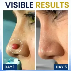 Skin Tag Cryo Treatment Spray Precision Cryo-Tech Freezes Away Skin Tags Warts in Seconds No Blades, No Pain - Image 3