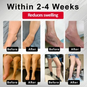 Advanced CVI Edema Therapy Cream - Image 2