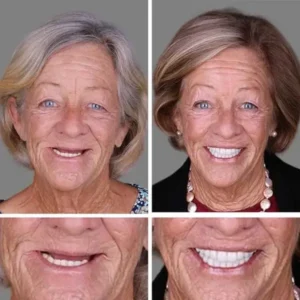 Advanced Customized Full Denture Set - Image 6
