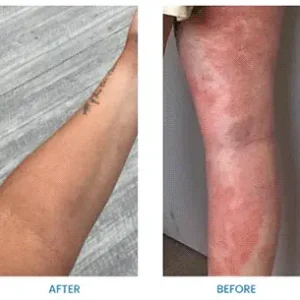 All Natural Eczema Soothing Cream - Image 3