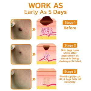 Bee Venom Mole and Wart Treatment Cream - Image 4