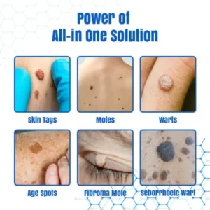 DermZap Mole & Wart Removal Laser Pen - Image 3