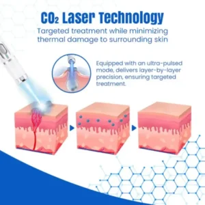 DermZap Mole & Wart Removal Laser Pen - Image 4