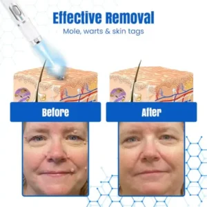 DermZap Mole & Wart Removal Laser Pen - Image 6