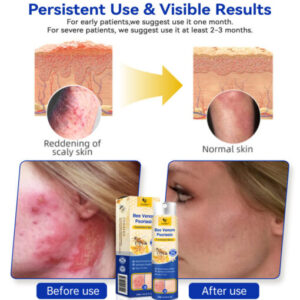 PsoriaHeal Bee Venom Psoriasis Treatment Spray plus - Image 4
