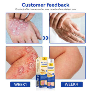 PsoriaHeal Bee Venom Psoriasis Treatment Spray plus - Image 5