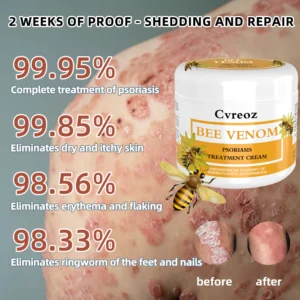 Cvreoz Bee Venom Psoriasis Treatment Cream - Image 2
