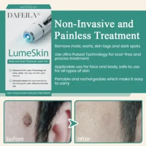 LumeSkin Mole and Wart Instant Removal Laser Pen - Image 4
