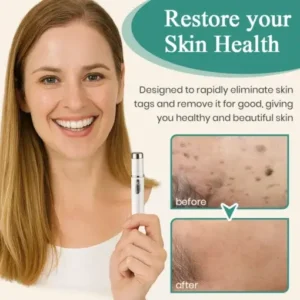 LumeSkin Mole and Wart Instant Removal Laser Pen - Image 6
