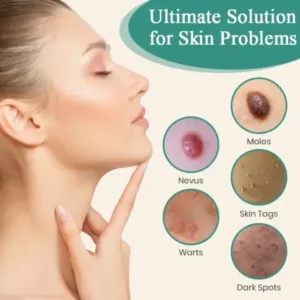 LumeSkin Mole and Wart Instant Removal Laser Pen - Image 8