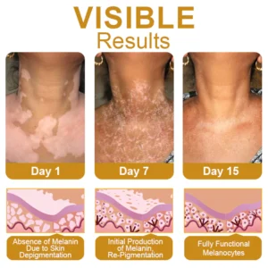 BeeVenom Vitiligo Treatment Cream - Image 4