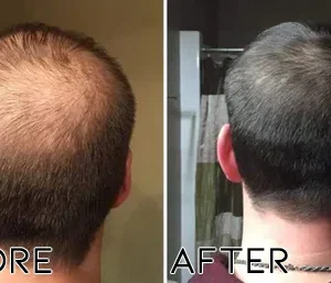 Minoxidil Hair Regrowth Treatment - Image 3