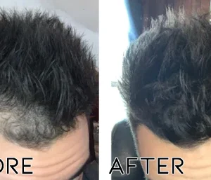 Minoxidil Hair Regrowth Treatment - Image 4